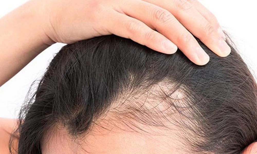 Τροφές κατά της τριχόπτωσης: Ποιες να εντάξετε στη διατροφή σας